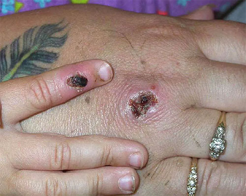 jpg Monkeypox causes lesions that resemble pus-filled blisters, which eventually scab over.